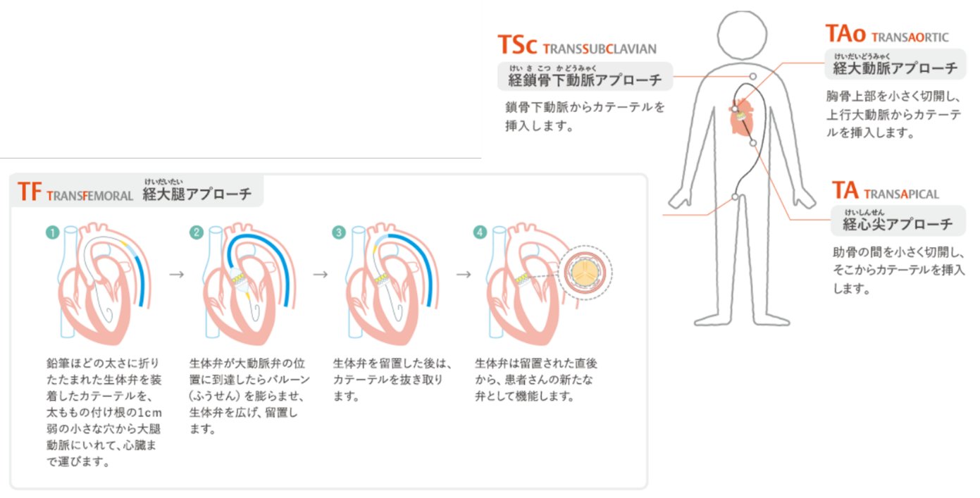 TAVIアプローチ