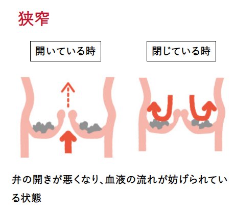 狭窄